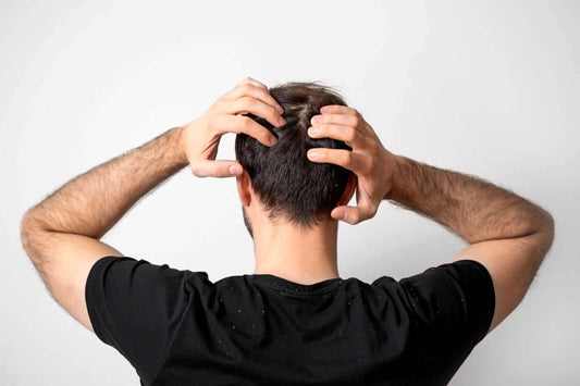 Een man krabt zijn hoofd vanwege zijn jeukende hoofdhuid