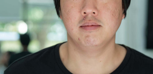 Man met puistjes in het gezicht